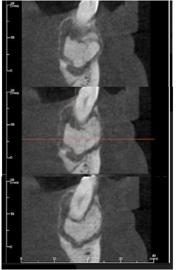 CORTE SAGITAL DE LA ZONA POSTEROINFERIOR IZQUIERDA