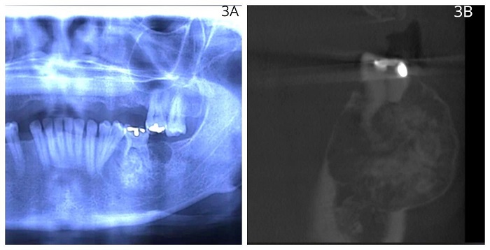A) RADIOGRAF&Iacute;A PANOR&Aacute;MICA QUE SE MUESTRA UNA LESI&Oacute;N MIXTA DIFUSA EN EL CUERPO MANDIBULAR IZQUIERDO. B) CORTE SAGITAL DE PRIMER MOLAR INFERIOR IZQUIERDO DONDE SE OBSERVA UNA LESI&Oacute;N HIPERINTENSA EN LOS TERCIOS MEDIO Y APICAL