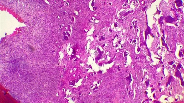 CORTE HISTOL&Oacute;GICO DE LA LESI&Oacute;N