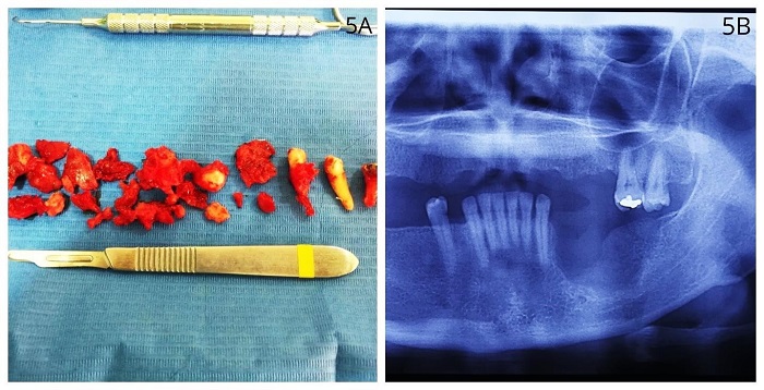 A). VISTA MACROSC&Oacute;PICA DEL ESP&Eacute;CIMEN QUE CONSIST&Iacute;A EN TEJIDO &Oacute;SEO Y DIENTES EXTRA&Iacute;DOS. 5) RADIOGRAF&Iacute;A POSTOPERATORIA INMEDIATA