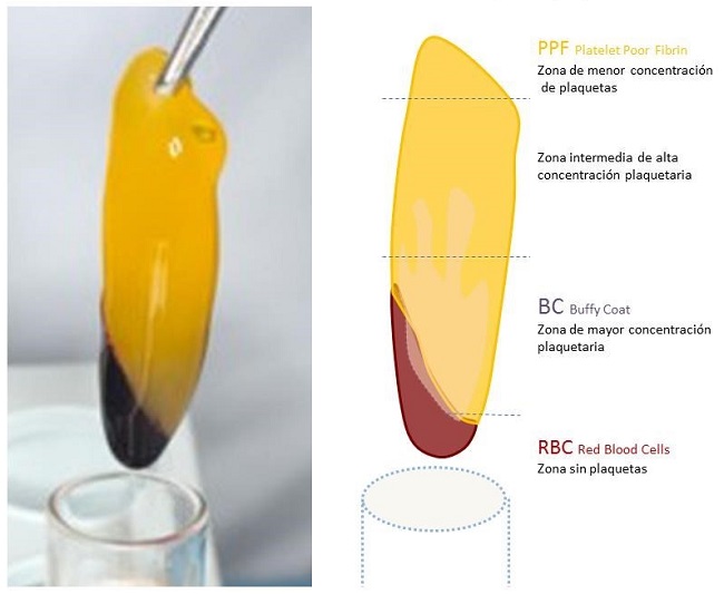ZONAS DE LA MATRIZ DE FIBRINA RICA EN PLAQUETAS (PRF)