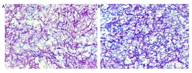 FIBRINA RICA EN PLAQUETAS ANTES Y DESPUS DE COMPACTARSE. A) PRF GEL B) PRF MEMBRANA