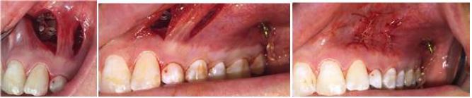 VISTA Technique Surgical Procedure, Case 1