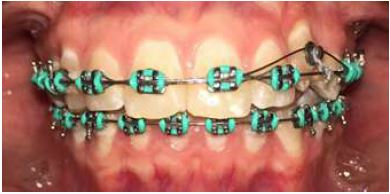 Adaptation of Nickel-Titanium Overarches and Elastic Wire on Tooth 23, Case 1