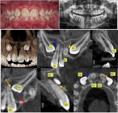 Initial Records: Photography, Orthopantomography and Cone Beam Tomography, Case 2