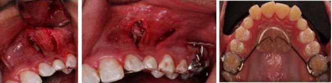 Surgical Procedure with VISTA Technique, Case 2