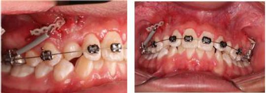 Activation of Chains on Teeth 13 and 23, Case 2