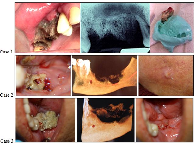 Characteristics of patients with osteoporosis and cancer with ONJ, cases 1-3