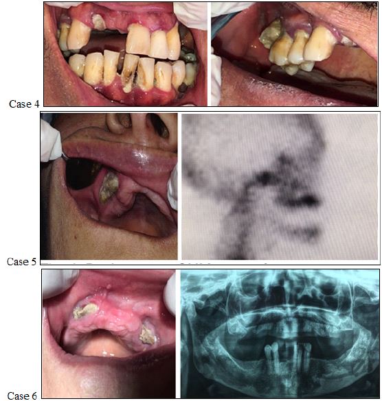Characteristics of patients with osteoporosis and cancer with ONJ, cases 4-6