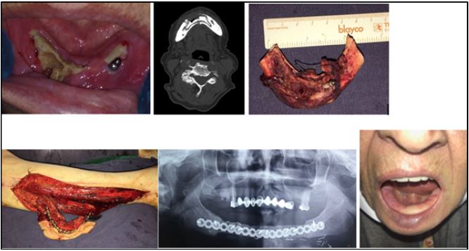 Characteristics of patients with osteoporosis and cancer with ONJ, case 7