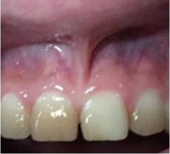 Gingival Insertion