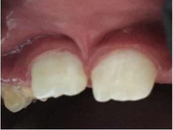 Penetrating Papillary Insertion