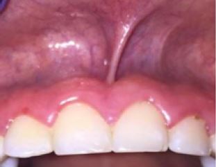 Mucosal Insertion
