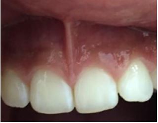 papillary Insertion