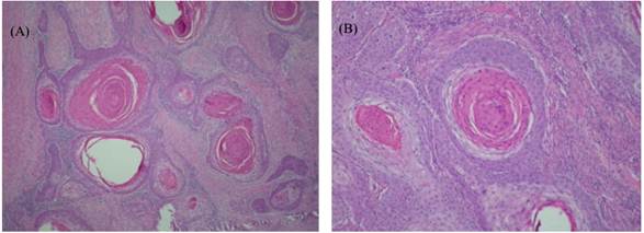(A) Tumoral mass formed by squamous cells from a round/oval nucleus, with an evident nucleolus, although doubled, fragmented chromatin and eosinophilic, abundant cytoplasm, forming invasive nests and cords in the dermis. (B) Proliferation of fibroblasts in the dermis and focal area of the necrosis in the epidermis (ulcer) with predominantly neutrophilic infiltration, basophilic granules (bacteria), with secondary lesions. HE, obj 40x.