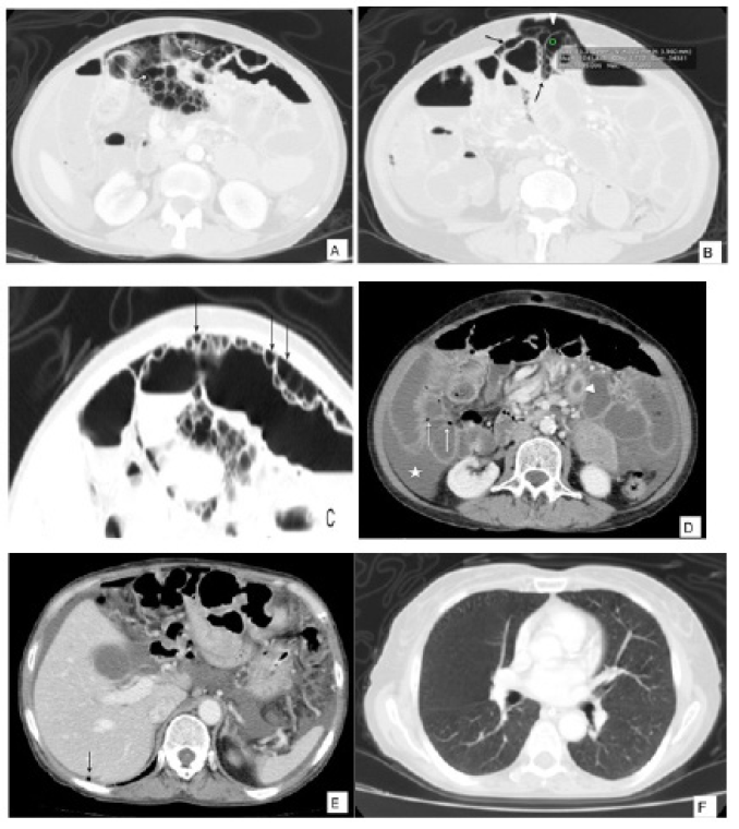 a, b. Tomografía computarizada (TC) contrastada de abdomen en ventana de pulmón donde se observan múltiples imágenes redondeadas localizadas en la pared del intestino delgado con densidad de aire (-1041 UH) (flechas blancas). Nótese el neumoperitoneo asociado (Cabeza de flecha) Figura 1 c. Magnificación de las imágenes hipodensas de la pared abdominal (flecha). Figura 1 d, e. TC de abdomen en ventana de tejidos blando donde se observa engrosamiento concéntrico y realce de la pared del yeyuno (cabeza de flecha blanca) además de liquido libre intra-abdominal (asterisco) e imágenes hipodensas en la pared del intestino delgado (flechas blancas). Aire libre en el hipocondrio derecho (flecha negra), no hay defecto de llenado ni aire en la vena porta. Figura 1e. Lo incluido de las bases pulmonares sin alteraciones parenquimatosas.