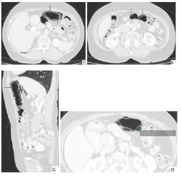 2b, 2c y 2d: TC de abdomen contrastada axial y sagital. Se observan múltiples imágenes quísticas (UH de -967) de morfología circular y lineal (flechas negras) en la pared del colon transverso, no se observan complicaciones. Diagnostico de neumatosis quística.