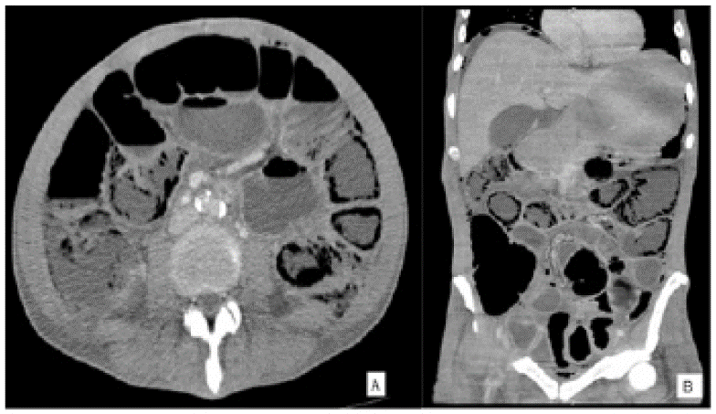 ay 3b. Tomografía contrastada axial y coronal donde se observa aire transmural en el colon con patrón lineal. En la reconstrucción coronal hay líquido peri hepático y aire libre, hallazgos secundarios a isquemia colónica.