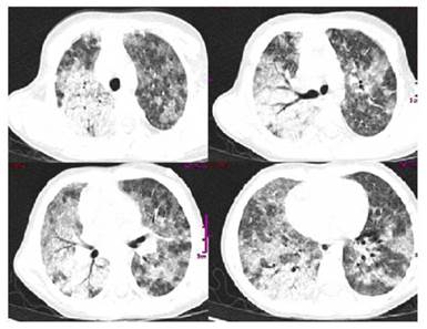 Chest CT scan. Bilateral multifocal frosted glass pattern. Pneumonic parenchymal consolidation in the right lung