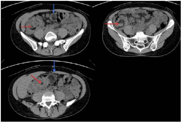 TAC simple de abdomen. La flecha roja señala el lipoma que actúa como punta de lanza a la cabeza de la intususcepción. La flecha azul evidencia la lesión en diana característica, la cual avanza hasta el colon transverso.