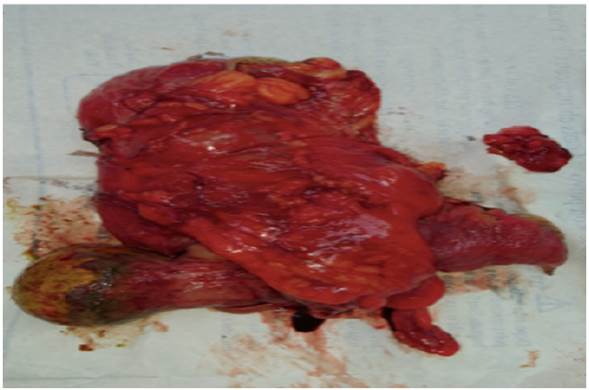 Espécimen resecado. La flecha señala el lipoma que actuó como punta de lanza para producir la intususcepción