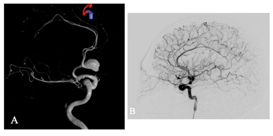 Angiografa de sustraccin digital en 3D A. Aneurisma cerebral del complejo comunicante anterior en su aspecto lateral izquierdo. B. Proyeccin lateral despus de la terapia embolizacin con coils (flecha).