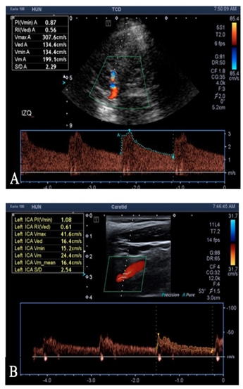 A. Ecografa Doppler transcraneal de arteria cerebral media y (B), de arteria cartida interna. Muestra un ndice de Lindegaard de 8,1.