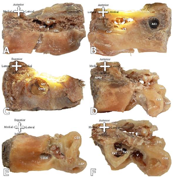 A. O&iacute;do medio derecho expuesto, vista superior M: Martillo, Y: Yunque, E: Estribo, MTT: M&uacute;sculo tensor del t&iacute;mpano, CAI: Conducto auditivo interno, CSL: Canal semicircular lateral; B. O&iacute;do medio derecho expuesto, vista inferior VR: Ventana redonda, ACI: Arteria car&oacute;tida interna, CSP: Canal semicircular posterior; C. Membrana timp&aacute;nica derecha expuesta, vista anterior MT: Membrana timp&aacute;nica, Omb: Ombligo de la membrana timp&aacute;nica; D. Canales semicirculares del o&iacute;do interno derecho, vista superior. V: Vest&iacute;bulo, NPM: Nervio petroso mayor, CSA: Canal semicircular anterior; E. Vest&iacute;bulo del o&iacute;do interno derecho, vista posterior OAI: Orificio auditivo interno; F. C&oacute;clea del o&iacute;do interno derecho expuesta, vista superior Mod: Modiolo, RaT: Rampa timp&aacute;nica, RaV: Rampa vestibular