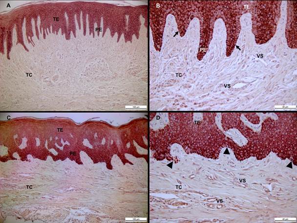 Localizaci&oacute;n inmunohistoqu&iacute;mica de la Citoqueratina I4 en tejido gingival. Epitelio gingival de individuo periodontalmente sano con lamina basal continua (flecha negra) (A, B). Epitelio gingival de paciente con AGTO (C, D). N&oacute;tese la fusi&oacute;n de las prolongaciones epiteliales (PE) y la perdida de continuidad de la membrana basal (triangulo negro) en pacientes con AGTO. TE: tejido epitelial; TC: tejido conjuntivo. VS: vasos sangu&iacute;neos. Barra negra: I00 um (A, C) y 40 um (B, D).