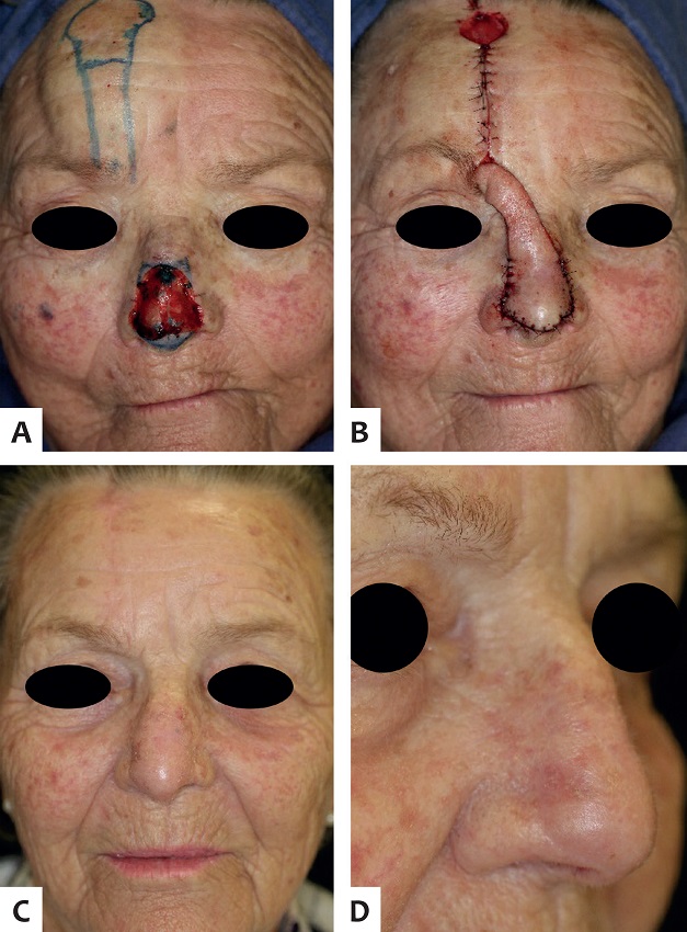 A - Defeito cirúrgico envolvendo ponta nasal, triângulos
							moles e dorso nasal. A porção remanescente da ponta nasal está demarcada
							para ser ressecada. A borda superior do defeito foi angulada para melhor
							acomodar o retalho. Notar anestesia generosa na área doadora, após
							bloqueio dos nervos supratroclear e supraorbital; B -
							Retalho paramediano frontal suturado no defeito nasal. A área doadora
							foi fechada de maneira primária parcialmente, e o restante deixado
							cicatrizar por segunda intenção; C - Cinco meses de
							pós-operatório. Notar cicatriz praticamente inaparente na região
							frontal; D - Visão oblíqua com restauração do contorno
							nasal. Incisões camufladas entre as subunidades nasais