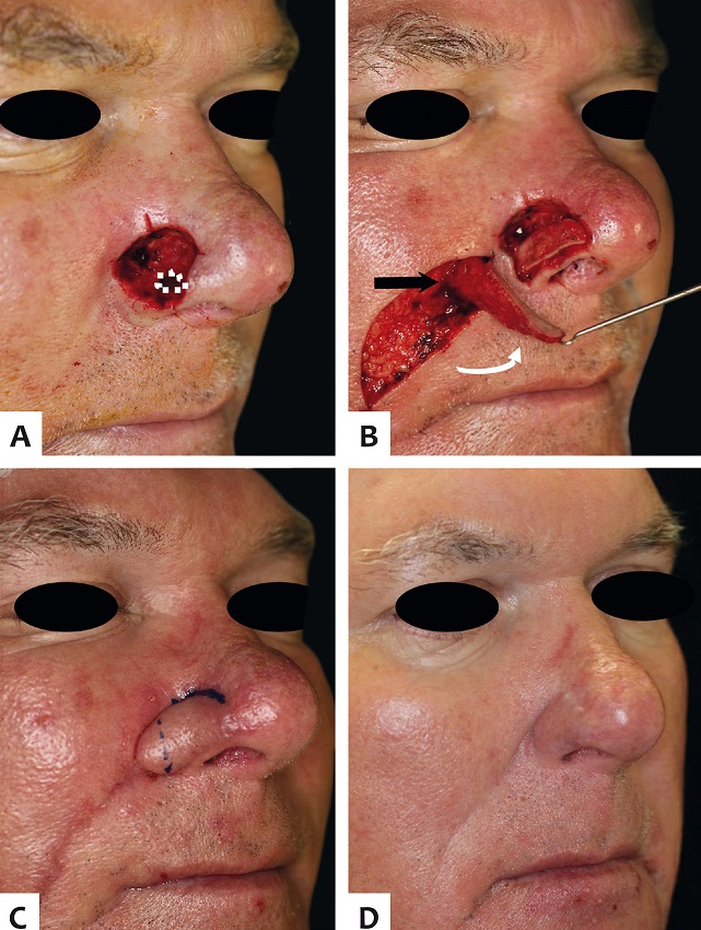 A - Defeito cirúrgico profundo em asa nasal direita com
							extensão para parede nasal direita. Uma pequena porção foi de espessura
							total (pontilhado) e foi fechada primariamente; B - Retalho
							elevado nos planos subcutâneo superficial na parte distal e subcutâneo
							profundo na porção proximal. Notar pedículo miocutâneo com fibras do
							músculo elevador do lábio superior e elevador da asa nasal (seta preta).
							Notar movimento do retalho no sentido anti-horário quando no lado
							direito (seta curva). Enxerto de cartilagem auricular suturado no
							defeito para evitar colabamento da asa nasal; C - Retalho
							previamente à divisão do pedículo e afinamento; D - Sete
							meses de pós-operatório com restauração da convexidade da asa nasal e
							preservação do sulco alar