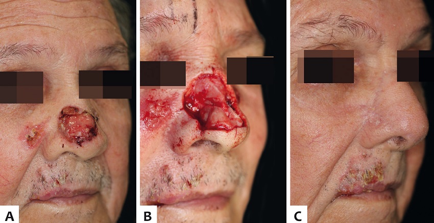 A - Carcinoma basocelular extenso em nariz. Notar outras
							lesões em região malar medial e lábio cutâneo superior; B -
							Ferida cirúrgica após cirurgia de Mohs. Múltiplas subunidades nasais
							afetadas, com perda importante de volume nasal; C - Quatro
							meses de pós-operatório com restauração da anatomia nasal e manutenção
							da função. Carcinoma basocelular malar foi reparado com retalho de
							avanço malar e enxerto de pele total no mesmo tempo do segundo estágio
							do RPF. A lesão em lábio cutâneo foi reparada posteriormente com retalho
							de transposição