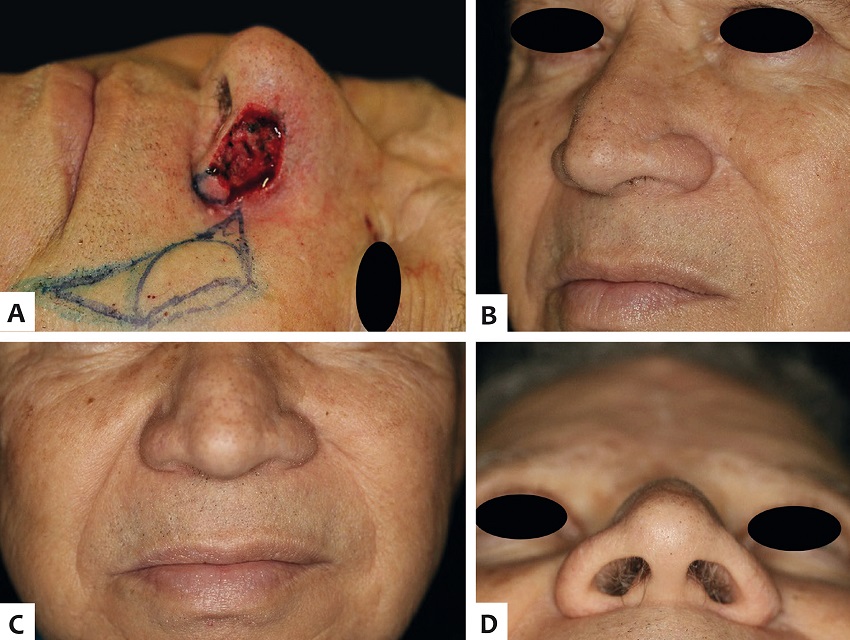 A - Defeito cirúrgico em asa nasal, após remoção da
							porção remanescente da subunidade da asa nasal, exceto pela porção
							lateral, que é removida na segunda cirurgia; B - Sete meses
							de pós-operatório, visão oblíqua; C - Visão frontal.
							Incisão camuflada no sulco nasogeniano esquerdo. Observar assimetria
							discreta dos sulcos, que pode ser notada em alguns pacientes; D
								- Visão inferior. Preservação do contorno alar sem
							comprometimento do vestíbulo nasal
