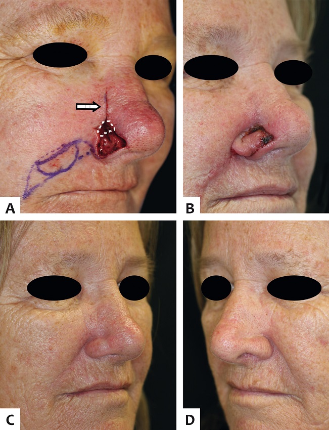A - Fechamento combinado para um defeito acometendo asa
							nasal direita e parede nasal. A porção superior da parede nasal foi
							fechada de maneira primária (seta branca), enquanto a porção inferior
							(linha pontilhada branca) foi deixada para cicatrizar por segunda
							intenção, ajudando na recriação do sulco alar. Apenas a asa nasal foi
							restaurada com o RISN; B - Dez dias de pós-operatório. A
							porção distal do retalho necrosou provavelmente devido ao excesso de
							“afinamento” durante o primeiro estágio; C - Seis meses de
							pós-operatório. Apesar da necrose de espessura parcial, não houve
							prejuízo do resultado final; D - Asa contralateral para
							comparação.