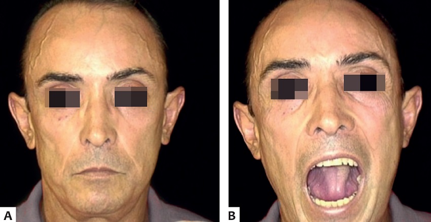 A - Presença de espessamento e rigidez da pele de
							maneira difusa na face; pele com aparência brilhante e tensa, com
							diminuição expressiva das rítides; afilamento do nariz B -
							Diminuição da abertura da A B rima bucal