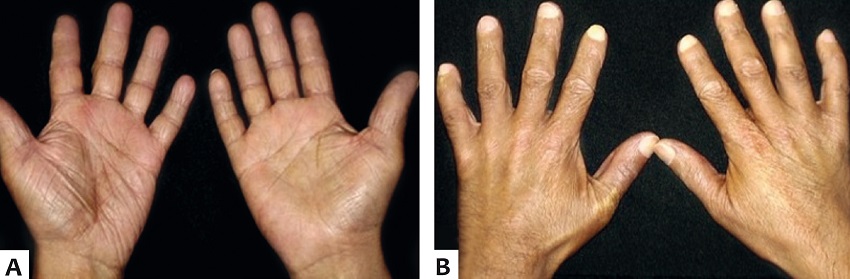 A - Dedos das mãos com tonalidade violácea distal
								B - Espessamento e rigidez da pele de dedos e
							mãos