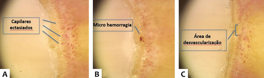 Capilaroscopia panorâmica periungueal evidenciando A -
							presença de intensa dilatação capilar, B - micro hemorragia
							moderada de padrão focal e C - moderada desvascularização
							de distribuição difusa e microangiopatia de padrão SD (scleroderma
							pattern) definida
