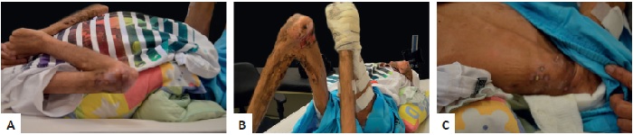 Aspecto cl&iacute;nico das feridas. A, B, C - apresenta&ccedil;&atilde;o
                                cl&iacute;nica do paciente com DMJ e m&uacute;ltiplas les&otilde;es