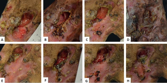 A-H - acompanhamento cl&iacute;nico da por&ccedil;&atilde;o lateral do joelho
                                esquerdo; A - semana 0 &ndash; primeira aplica&ccedil;&atilde;o da cultura
                                aut&oacute;loga de fibroblastos e queratin&oacute;citos com membrana de Q-A &ndash;
                                notar a exposi&ccedil;&atilde;o &oacute;ssea; B - semana 3 &ndash; segunda
                                aplica&ccedil;&atilde;o &ndash; presen&ccedil;a de crosta e in&iacute;cio da cicatriza&ccedil;&atilde;o centr&iacute;peta;
                                    C - semana 4 &ndash; 75% de melhora; D -
                                semana 6 &ndash; terceira aplica&ccedil;&atilde;o &ndash; notar a membrana de Q-A aplicada;
                                    E - semana 21 &ndash; quarta aplica&ccedil;&atilde;o &ndash; completa
                                reepiteliza&ccedil;&atilde;o da por&ccedil;&atilde;o distal da &uacute;lcera; F - semana
                                28 &ndash; quinta aplica&ccedil;&atilde;o &ndash; devido &agrave; atividade da doen&ccedil;a, uma progress&atilde;o
                                da ferida foi observada (de 0,88cm2 para 1,22cm2);
                                    G - semana 42 &ndash; sexta aplica&ccedil;&atilde;o, progress&atilde;o da
                                extens&atilde;o da &uacute;lcera (de 1,22cm2
                                para 1,43cm2) com melhora em
                                rela&ccedil;&atilde;o &agrave; profundidade da les&atilde;o; H - semana 64 &ndash; 87,85%
                                de melhora