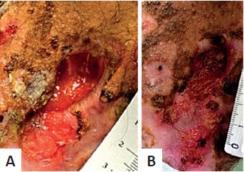 Seguimento do joelho direito por&ccedil;&atilde;o lateral: (A) semana
                            0; (B) semana 79