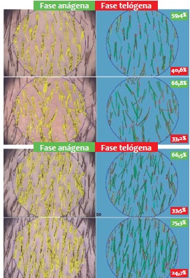 Fototricogramas digitais realizados em dois volunt&aacute;rios; as
                                imagens superiores correspondem &agrave; visita inicial, as inferiores &agrave;
                                visita final; a escala lateral representa a propor&ccedil;&atilde;o de fios
                                an&aacute;genos e tel&oacute;genos
