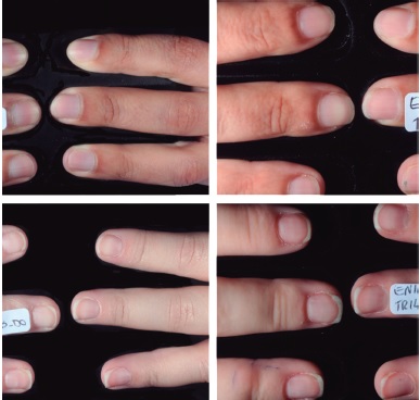 Fotografias cl&iacute;nicas de unhas de dois volunt&aacute;rios do estudo; &agrave;
                                esquerda na visita inicial, &agrave; direita na visita final