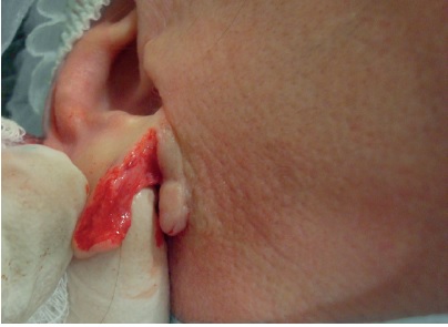 Borda da ferida desbridada ap&oacute;s ruptura do l&oacute;bulo da orelha