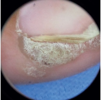 Verruga viral periungueal, com acometimento da dobra ungueal
                                lateral no primeiro quirod&aacute;ctilo direito