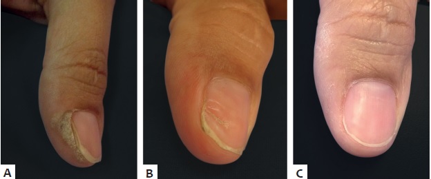 A - Verruga viral periungueal B - Ap&oacute;s
                                quatro semanas de terapia intralesional com bleomicina
                                    C - Sete meses ap&oacute;s sess&atilde;o &uacute;nica de terapia
                                intralesional com bleomicina, resolu&ccedil;&atilde;o completa das les&otilde;es