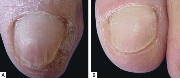 A - Verruga viral periungueal no h&aacute;lux esquerdo h&aacute;
                                cinco meses, sem resposta a diversos tratamentos t&oacute;picos
                                    B - Seis meses ap&oacute;s sess&atilde;o &uacute;nica de infiltra&ccedil;&atilde;o
                                intralesional com bleomicina