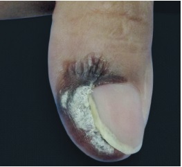 Quatro dias ap&oacute;s o procedimento, demonstrando seus sinais
                                caracter&iacute;sticos