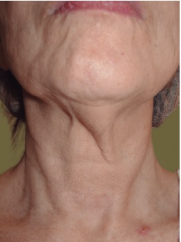 Pré-operatório: bandas platismais visíveis e assimétricas, acúmulo de
                            gordura submentoniana, flacidez do pescoço e terço inferior da
                            face