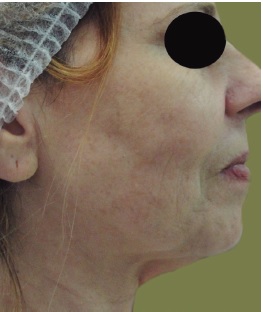Pré-operatório, perfil: apagamento do contorno da mandíbula, ptose
                            das bandas platismais com aumento do ângulo cérvicomandibular e acúmulo
                            de gordura submentoniana