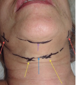 Marcação cirúrgica. 1- Setas vermelhas, ramo marginal da
                            mandíbula do N. facial.; 2- setas amarelas, bandas
                            platismais; 3- seta azul, ângulo cérvico-mandibular onde
                            sai a agulha de Casagrande com o fio; 4- seta roxa, prega
                            submentoniana onde entra a cânula para lipoaspiração da parte
                            anterior